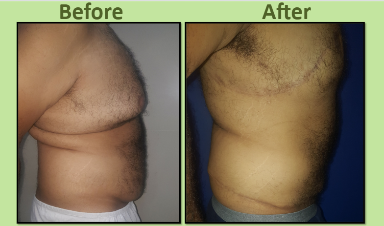 Gynecomastia after weight loss surgery Surat