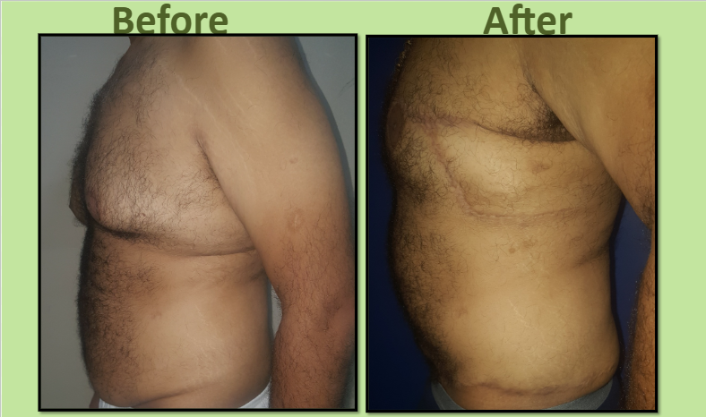 Loose chest skin removal male Surat