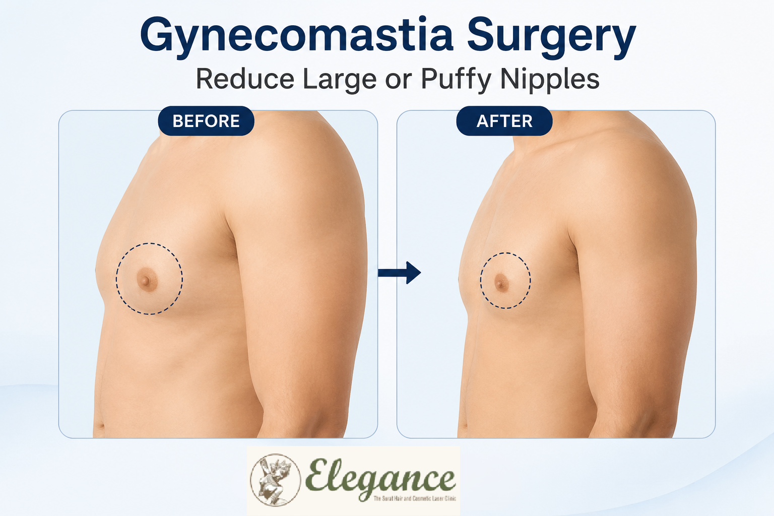 Can Gynecomastia Surgery Reduce Large or Puffy Nipples?