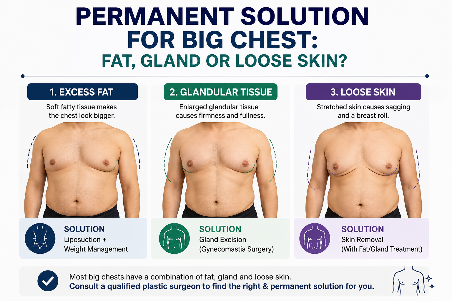 Permanent Solution for Big Chest: Fat, Gland or Loose Skin?