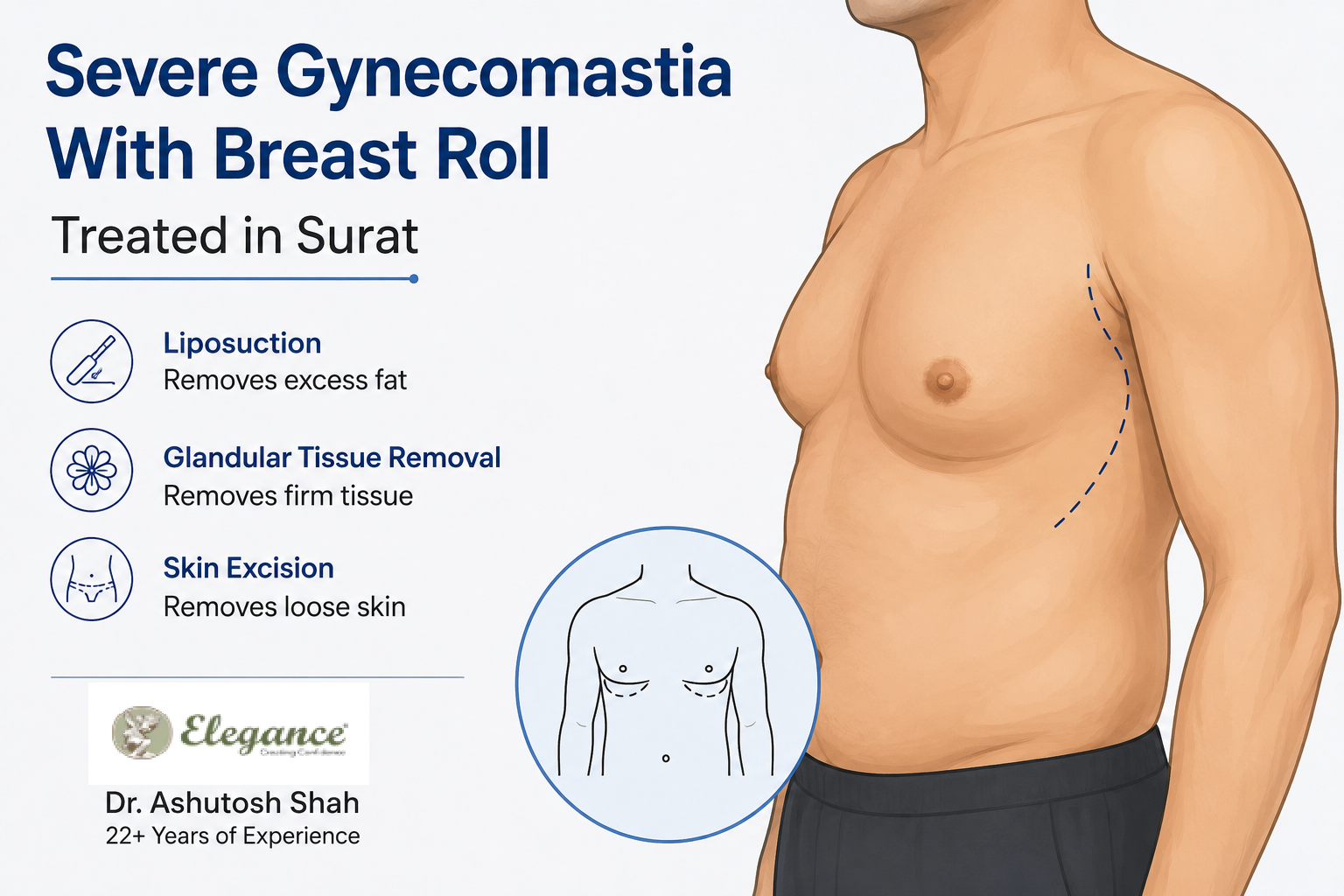 How Is Severe Gynecomastia With a Breast Roll Treated in Surat?