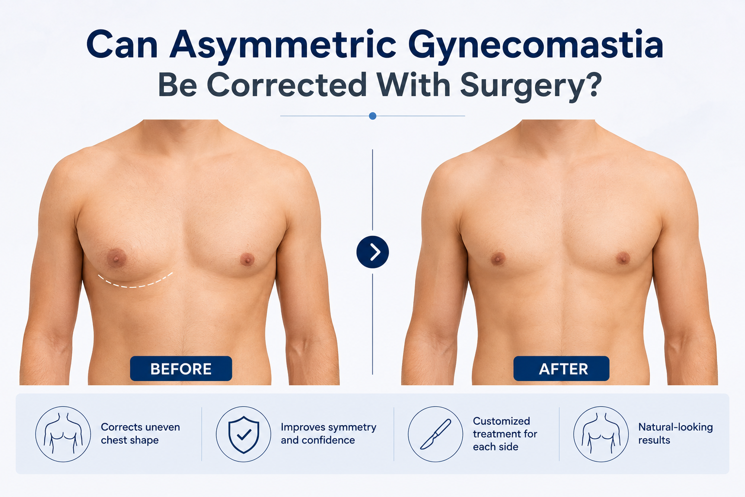 Can Asymmetric Gynecomastia Be Corrected With Surgery?