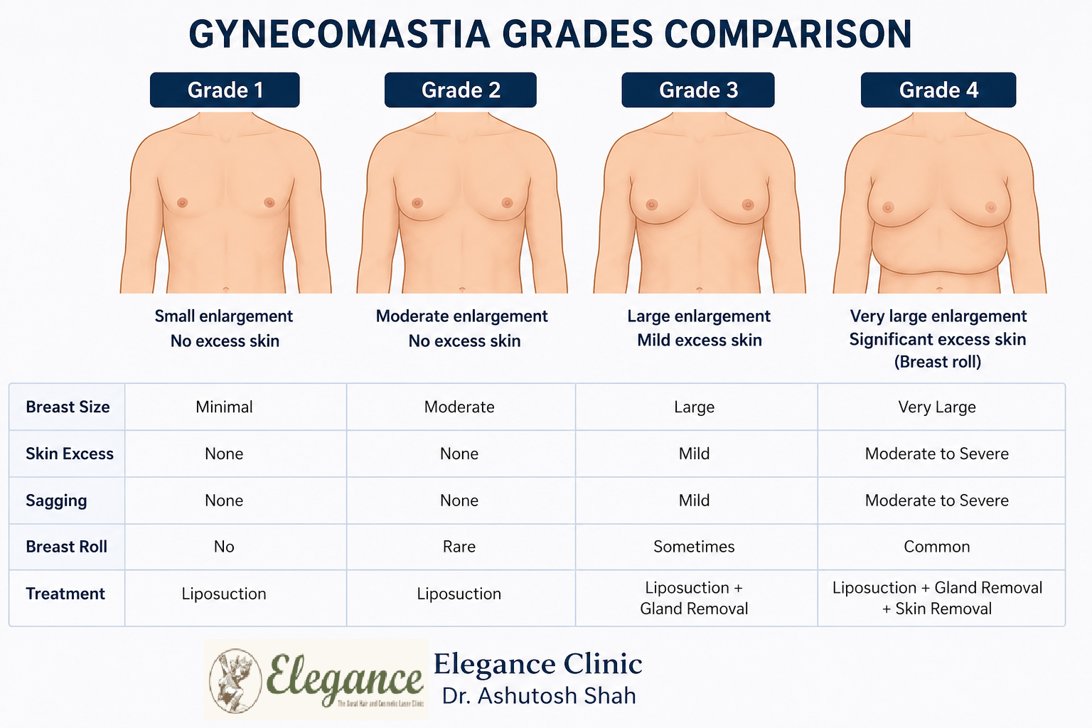 How Is Type 4 Gynecomastia Different From Other Grades?